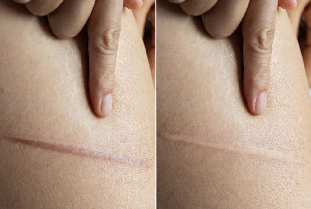 Narbenbehandlung Behandlung