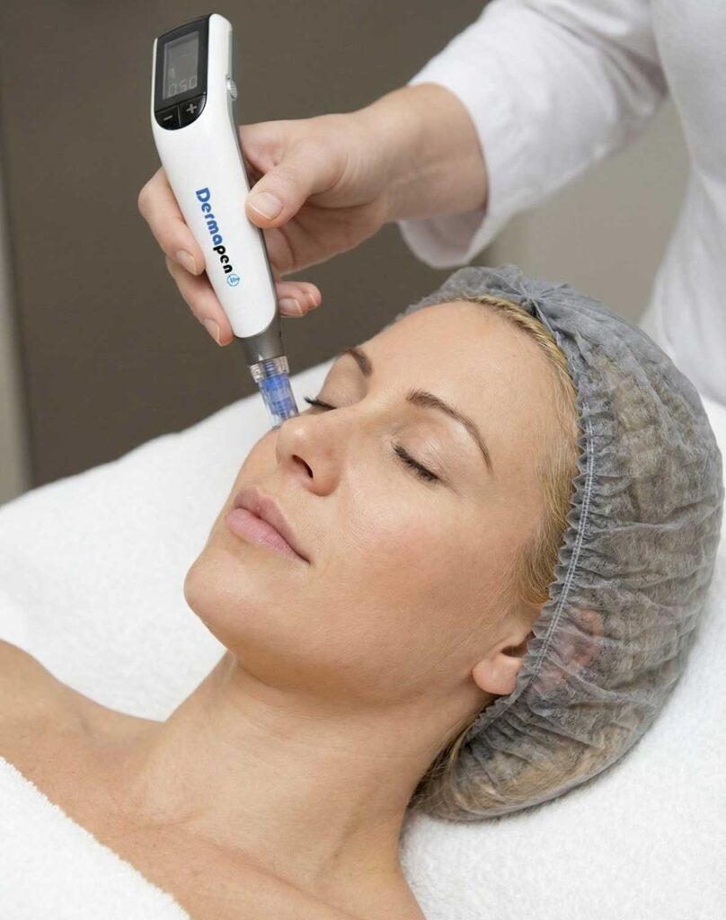 Ist Microneedling schmerzhaft