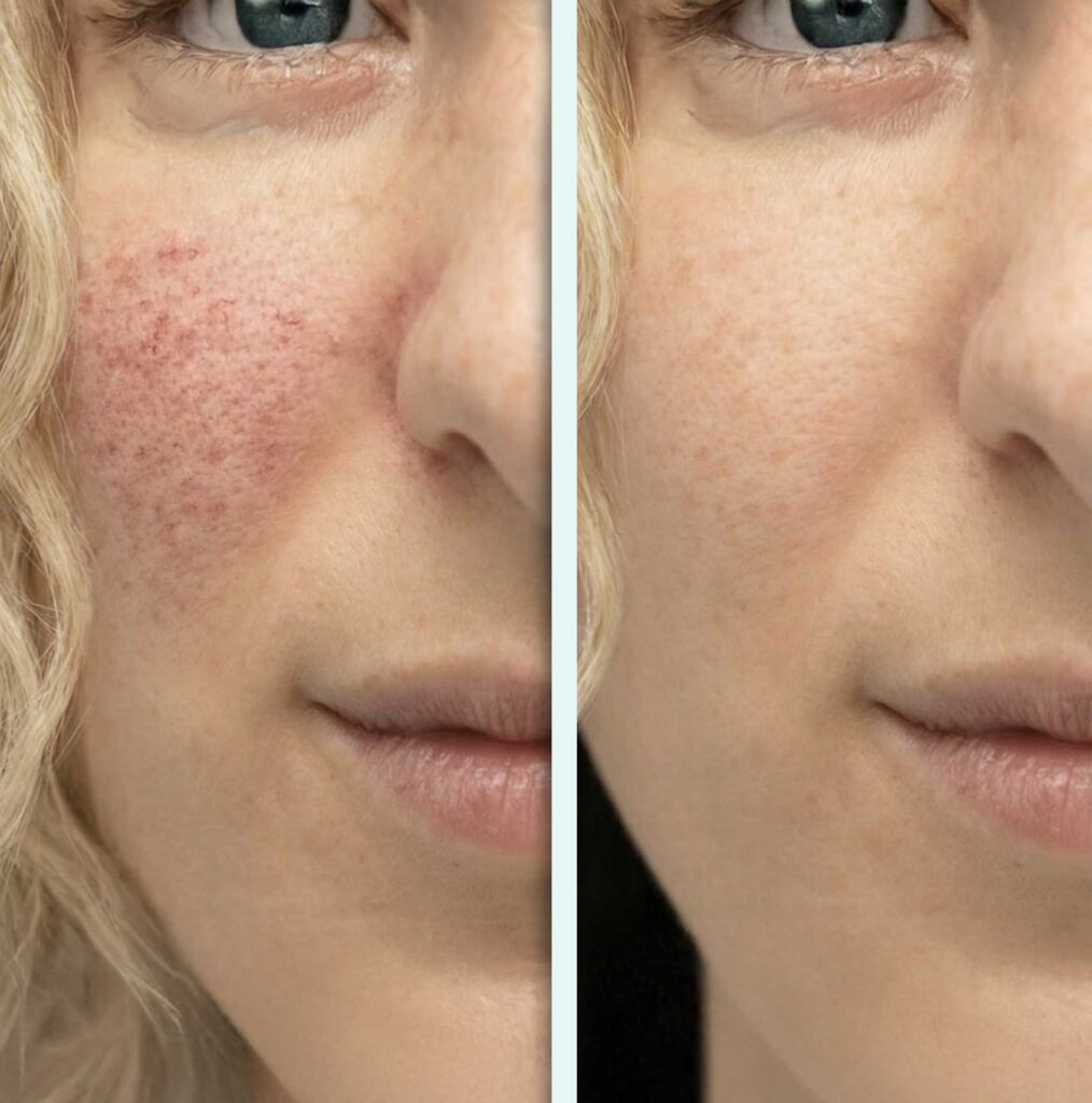 Rosazea-behandlung-before-and-after1