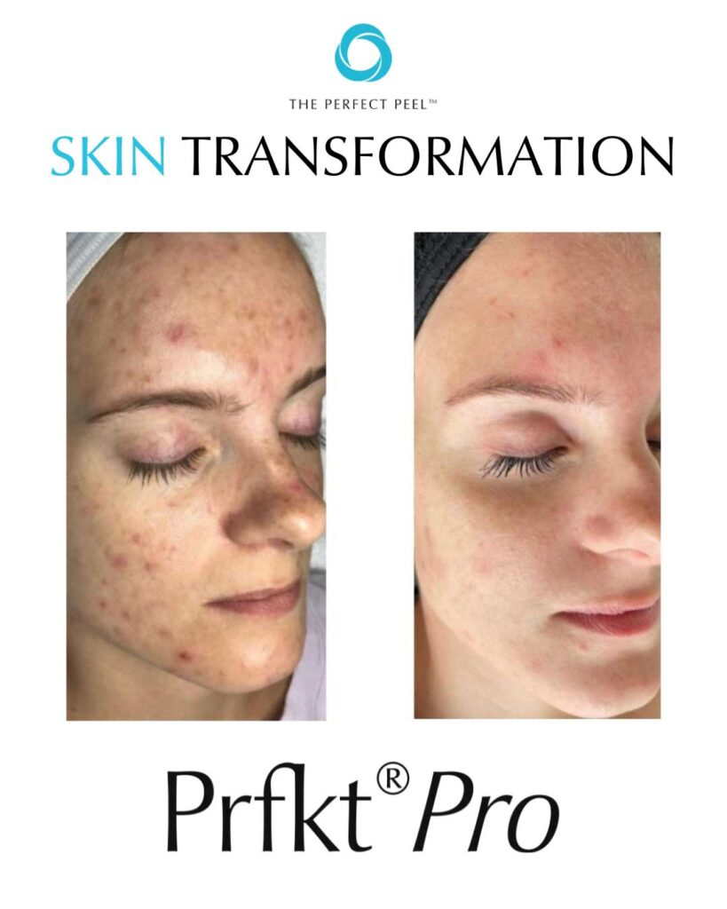 acne before and after