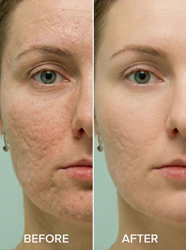 Aknenarben entfernen-before and after