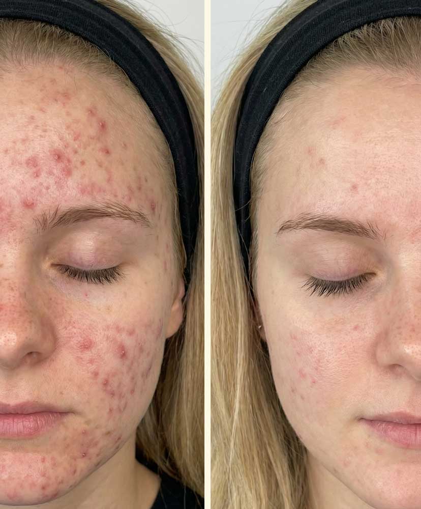 Aknenarben-microneedling