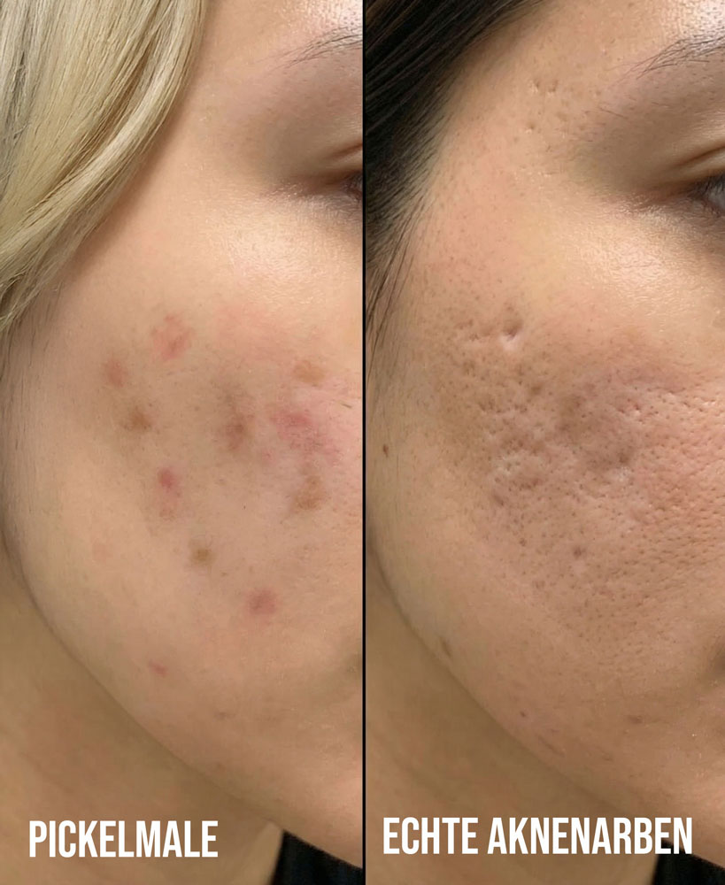 Aknenarben oder Pickelmale