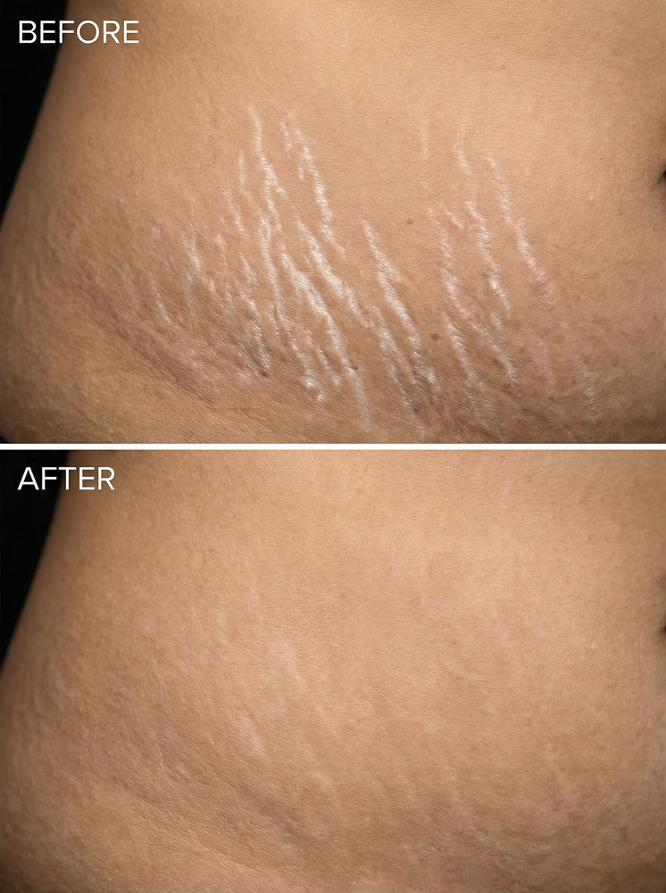 Dehnungsstreifen entfernen München before and after