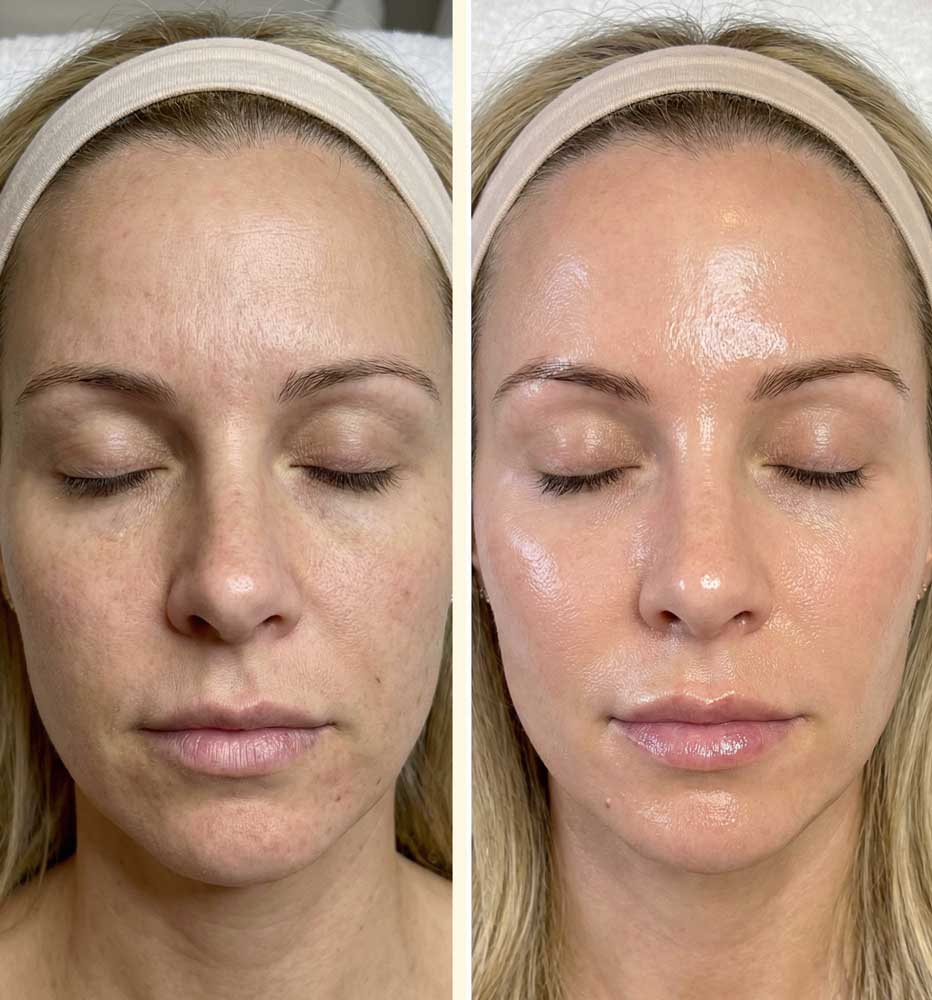 HydraFacial Vorher Nachhe