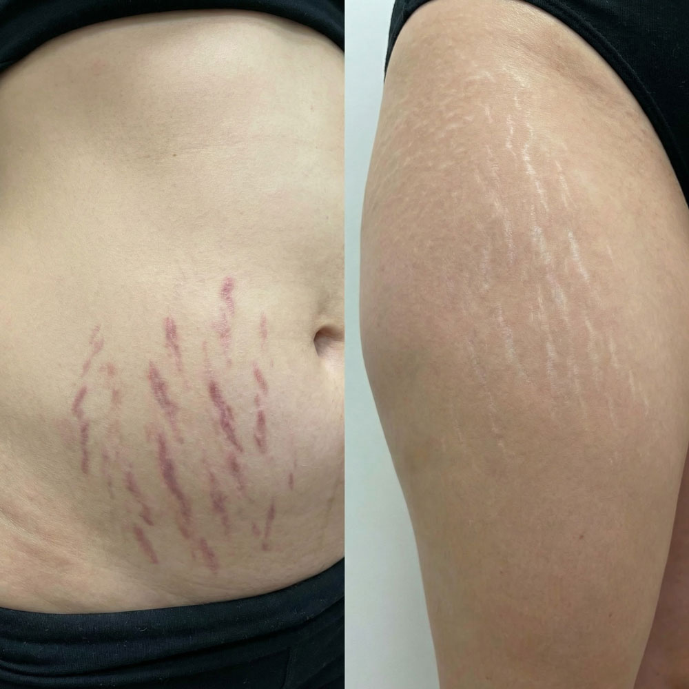 Rote vs. Weiße Dehnungsstreifen