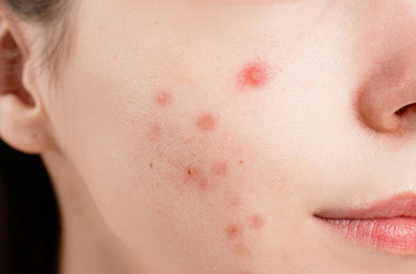 mirela the facialist akne