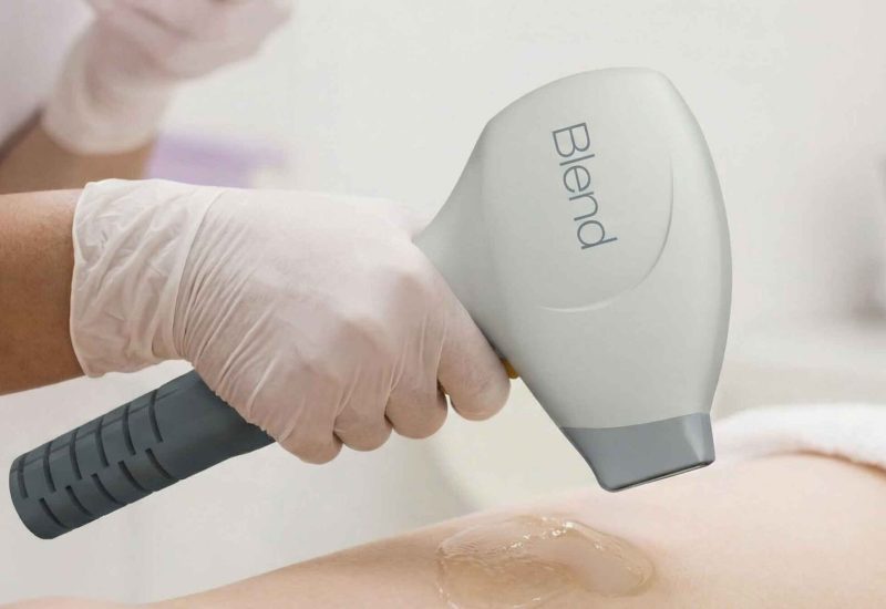 Dauerhafte Haarentfernung Intimbereich & Brazilian München