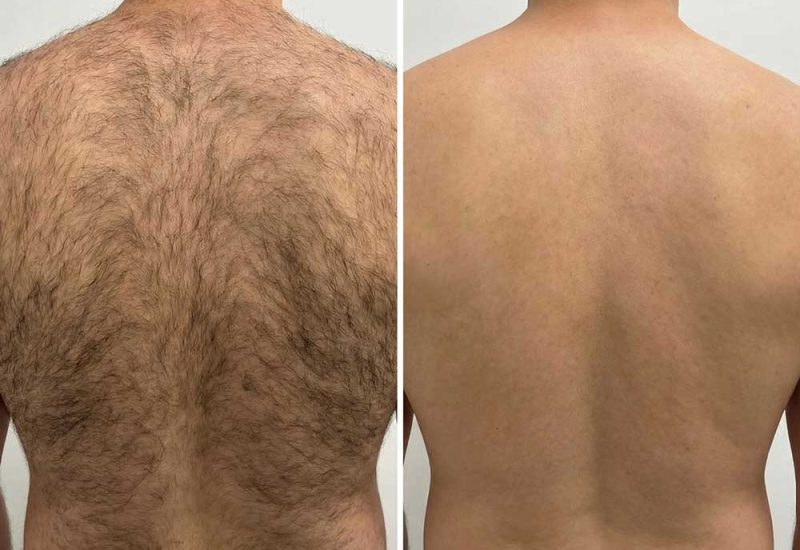 Haarentfernung-rücken,-schultern-&-nacken-München before after.jpg